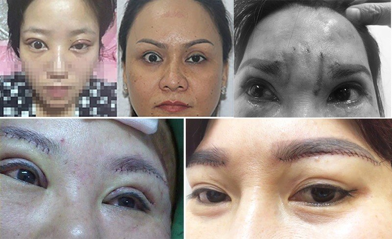 Nâng cung mày bị hỏng có thể xảy ra khi thực hiện ở cơ sở kém uy tín