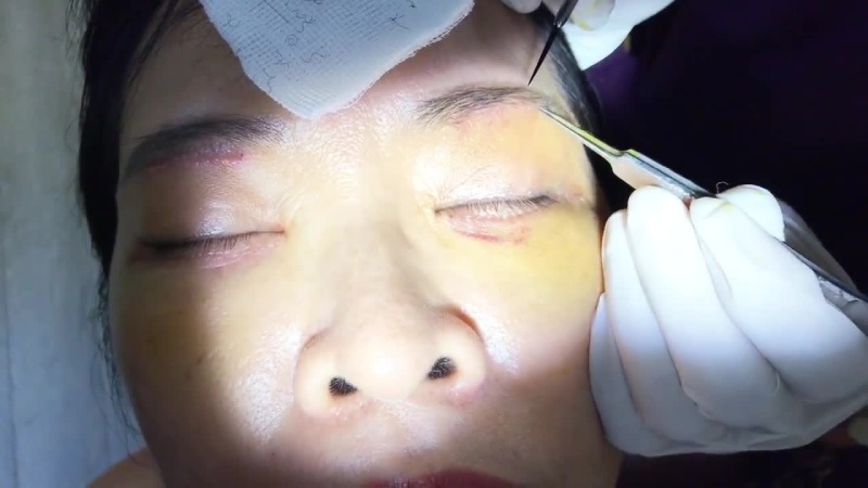 Nâng cung mày có thể bị co rút mi nếu thực hiện ở địa chỉ kém uy tín