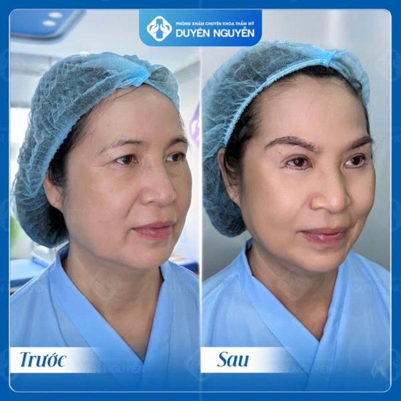 Phẫu thuật giúp chị em không còn lo lắng nâng cung chân mày bị hỏng