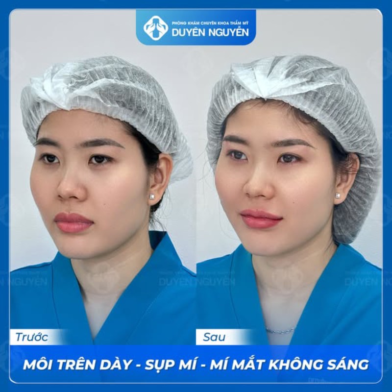 Sau 1-2 tháng chị em có thể cân nhắc khắc phục nâng cung mày bị hỏng