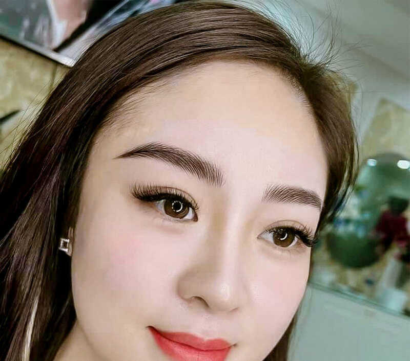 Vết sẹo sau khi nâng cung chân mày hầu như không nhìn thấy