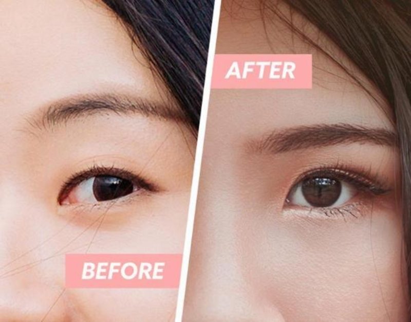 Cắt mí phù hợp với chị em mắt một mí, mí lót