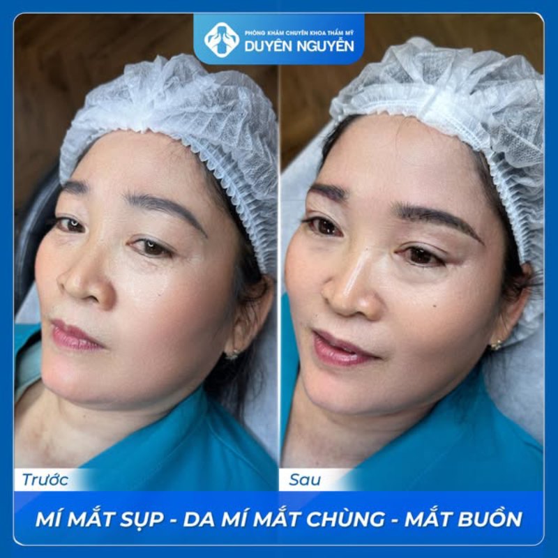 Treo cung mày xử lý mí mắt sụp, tình trạng mắt buồn