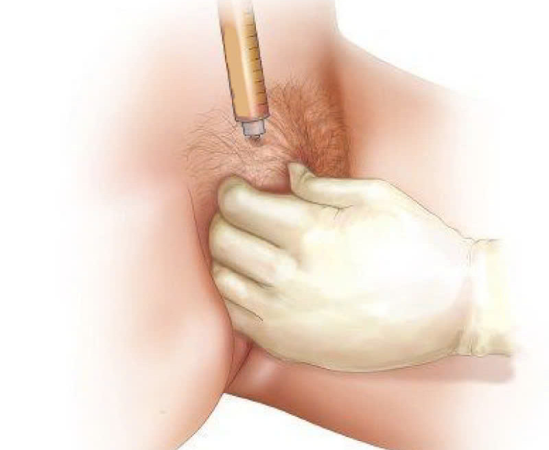 Cấy mỡ môi lớn là phương pháp làm đẹp an toàn