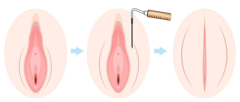 Quy trình thực hiện cấy mỡ cô bé