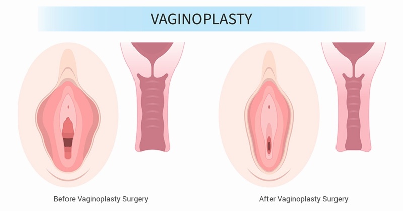 Có nên làm trẻ hóa vùng kín không, nên nếu có nhiều thay đổi gây tự ti