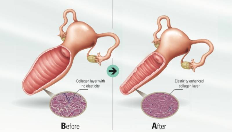 Có nên làm trẻ hóa vùng kín không, giải pháp giúp cô bé đàn hồi và se khít