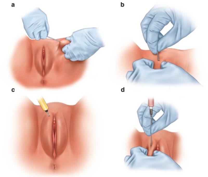 Có nên làm trẻ hóa vùng kín không, cấy mỡ trẻ giúp cô bé hồi sinh độ căng mọng