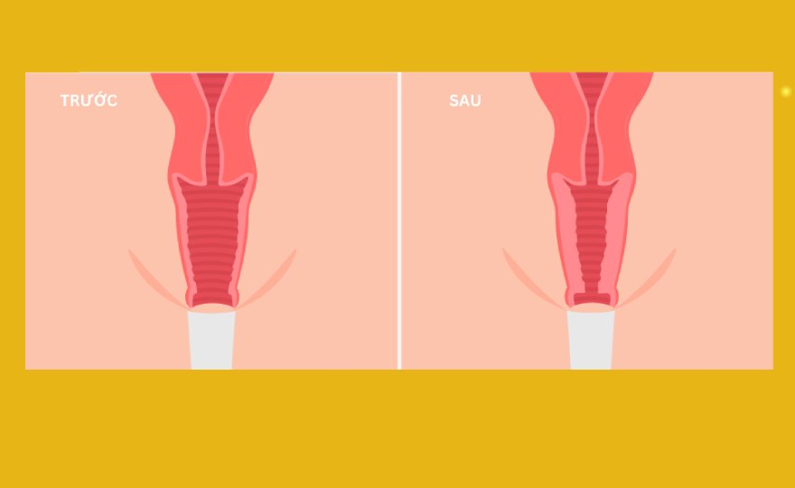 Có nên thu hẹp vùng kín sau sinh, cải thiện độ sẽ khít rõ rệt