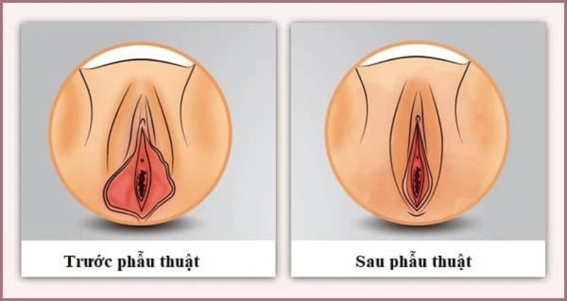 Có nên thu hẹp vùng kín sau sinh, chị em có thể thực hiện mà không lo ảnh hưởng sinh nở