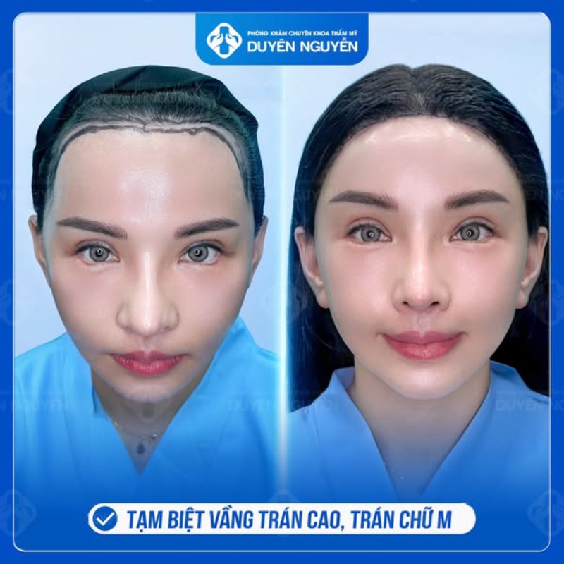 Người có trán cao, trán chữ M nên hạ đường chân tóc