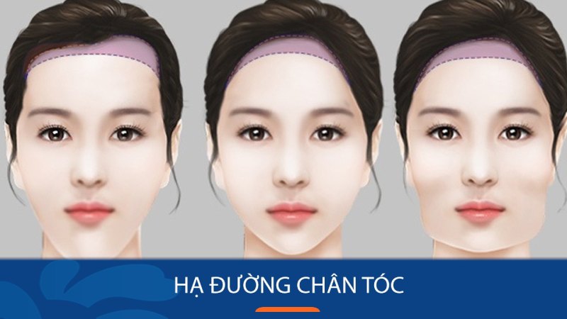 Mô tả phẫu thuật hạ đường chân tóc cho các khuôn mặt