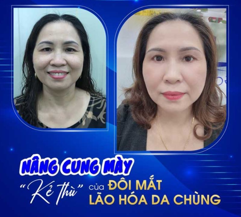 Nâng cung mày cải thiện cung mày sụp lão hóa, sa trễ