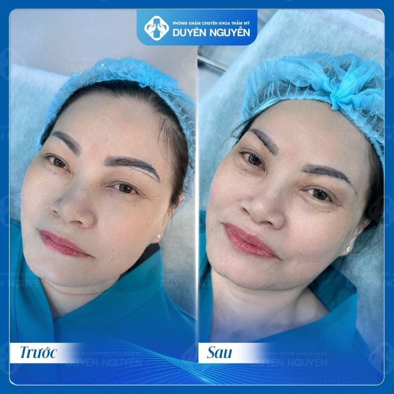 Nâng cung mày giúp chị em lấy lại sự trẻ trung từ đó có những thay đổi tích cực